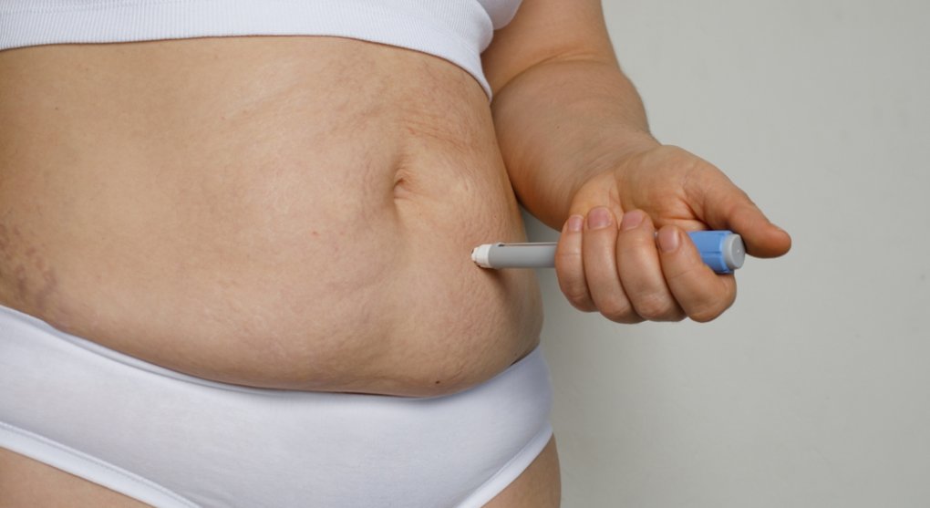 Léky na hubnutí? Žádný vás nezbaví tuku, aby svaly zůstaly, zdůrazňuje obezitolog